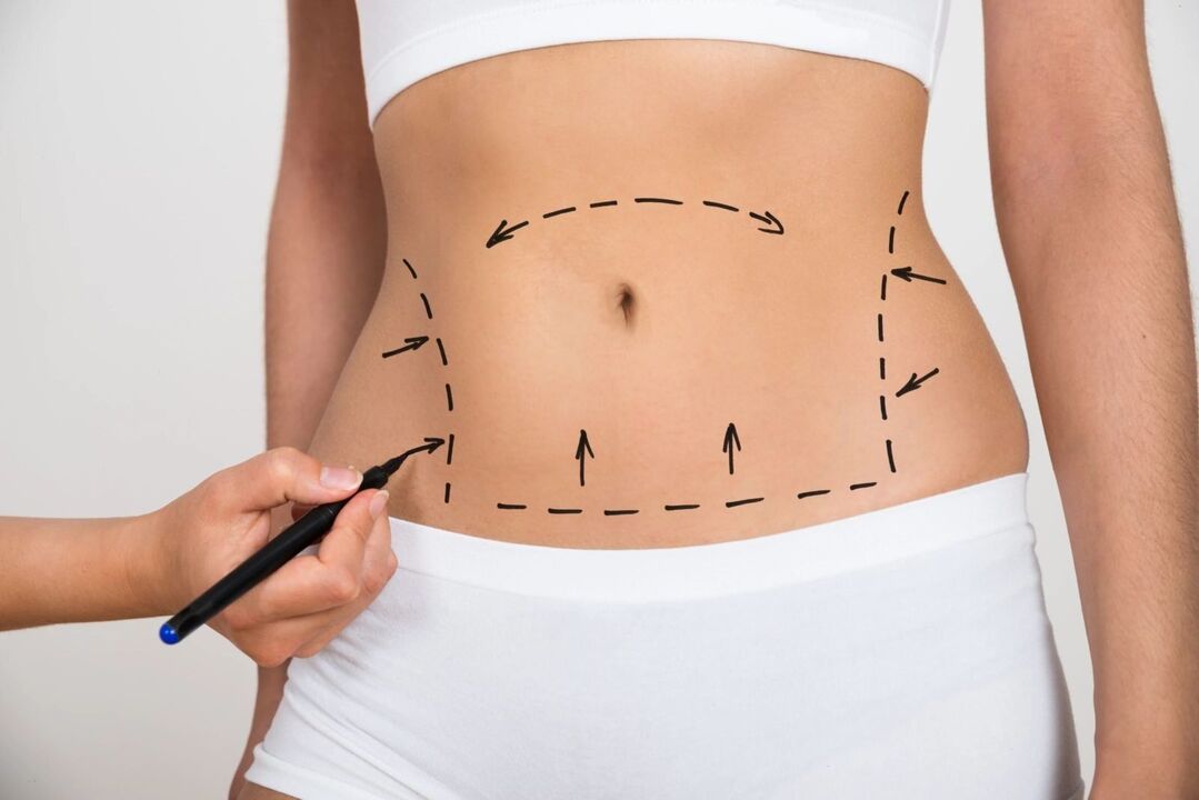 Marking on the abdomen before the liposuction, correcting the figure
